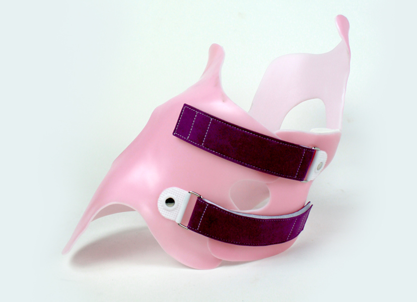 Cheneau-Gensingen brace represents a non-surgical treatment option that actually corrects the patient’s curved spine.