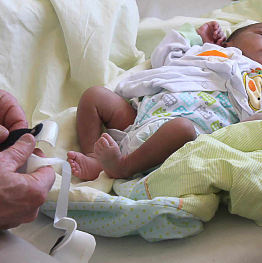 Baby with club foot being fitted with the Cunningham Brace by Jerald Cunningham