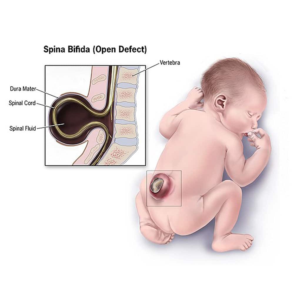 Baby with spina bifida