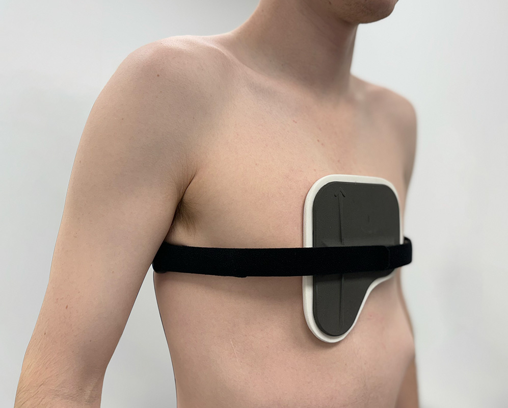 Dynamic chest compressor orthosis for pectus carinatum