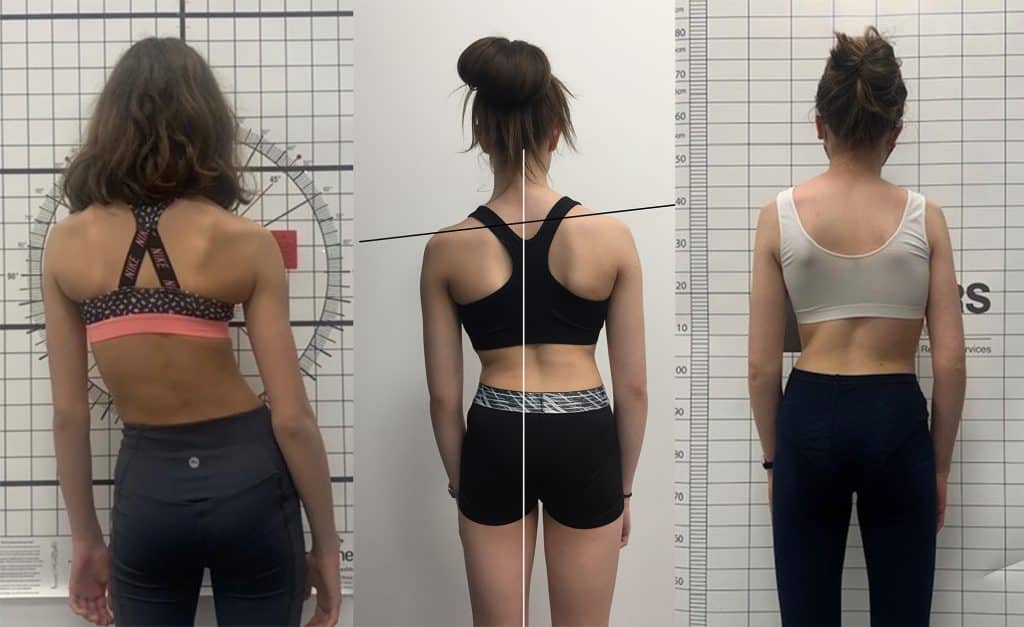 Visual signs of scoliosis in female adolescent patients
