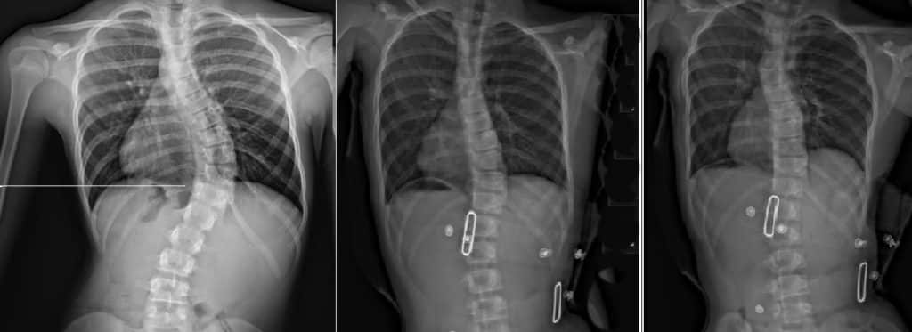Before and after X-rays of an adolescent scoliosis bracing patient treated at the London Orthotic COnsultancy