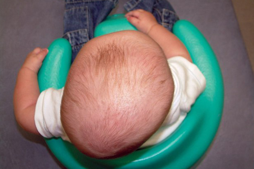 A top to down view of a baby sitting in a green bumbo seat, showing flattened area on the back of their head
