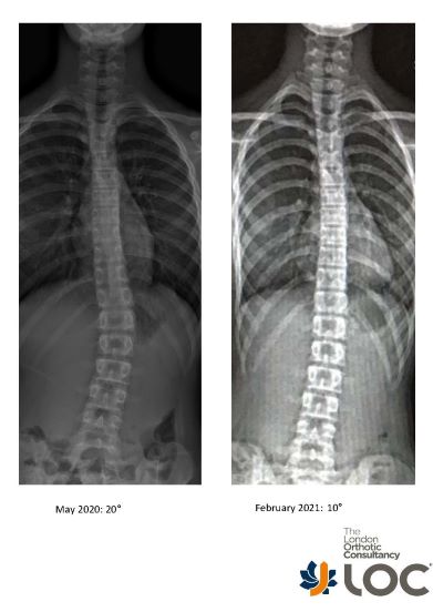 Daisy’s scoliosis scans from May 2020 and February 2021, highlighting the significant improvement and effectiveness of her bracing treatment