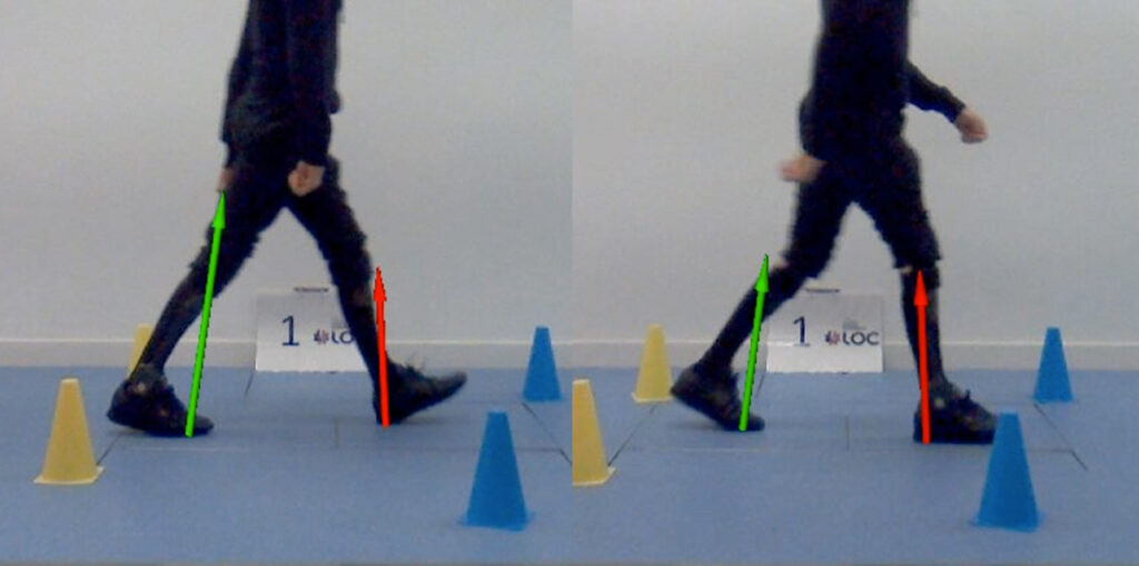 Charcot Marie Tooth patient, with drop foot, wearing Neuro Swing AFOs