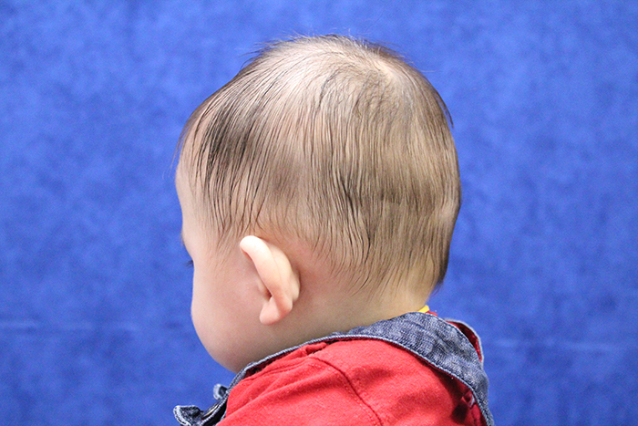 photograph of the back of baby head with Plagiocephaly
