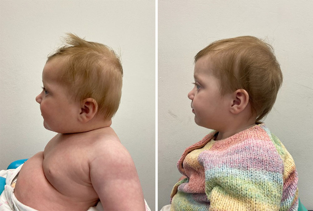 Before and after results of baby treated with flat head syndrome