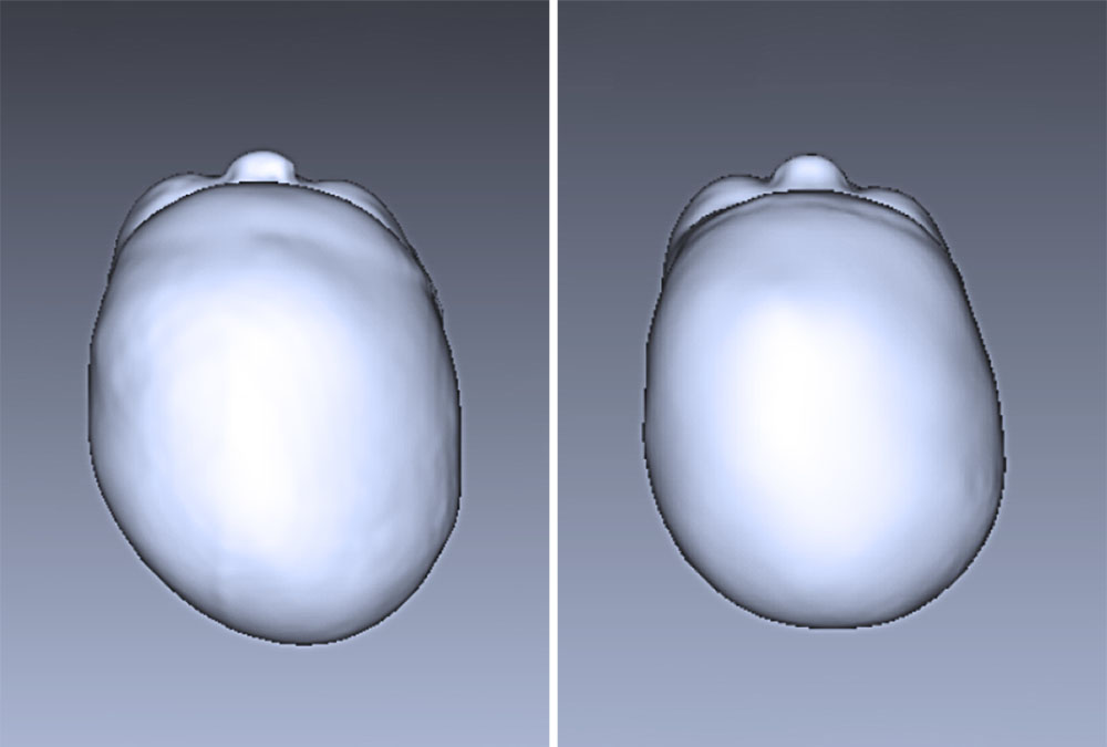 Before and after head scans of Amelia, showing a decrease in cranial asymmetry from 18 mm to 9 mm following treatment