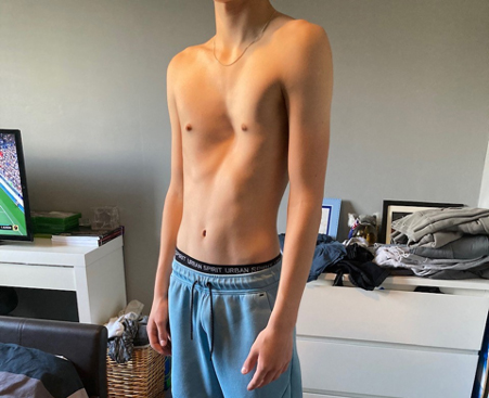 Teenage boy with severe dent in his chest from pectus excavatum