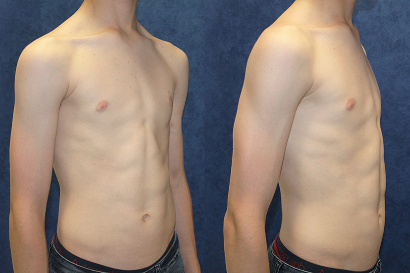 Before and after chets bracing results for 14 year old pectus carinatum patient