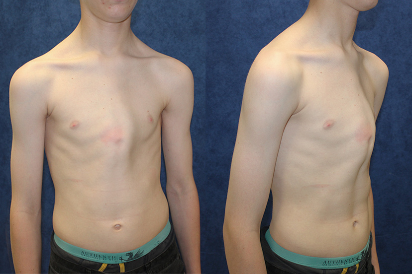 Tennage patient with pectus carinatum before chest bracing treatment