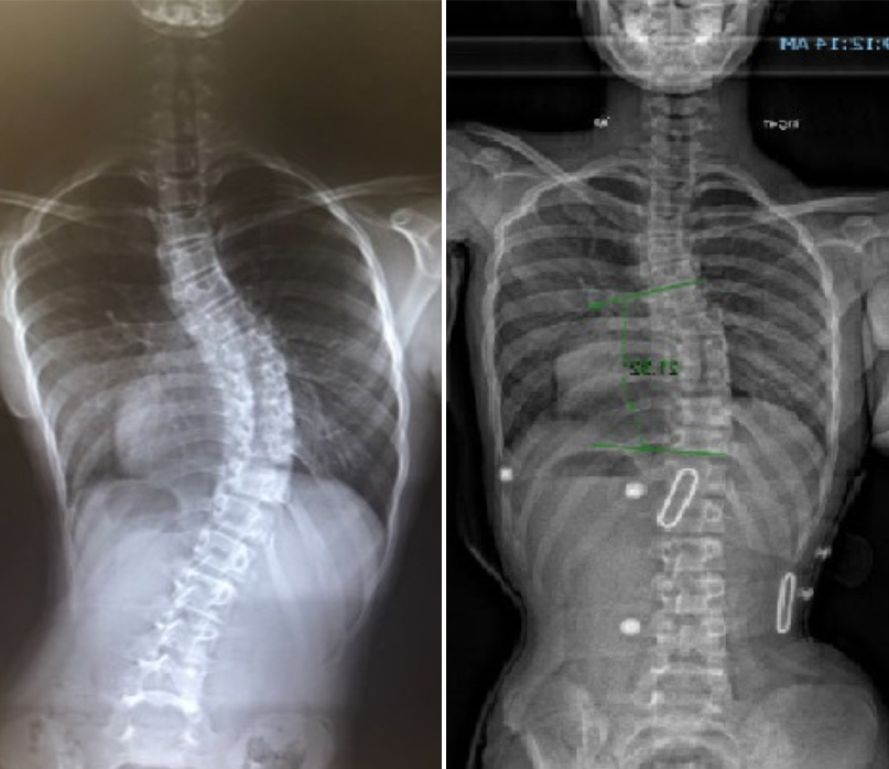 before and after scan of a patient spin after using the Scoliosis brace