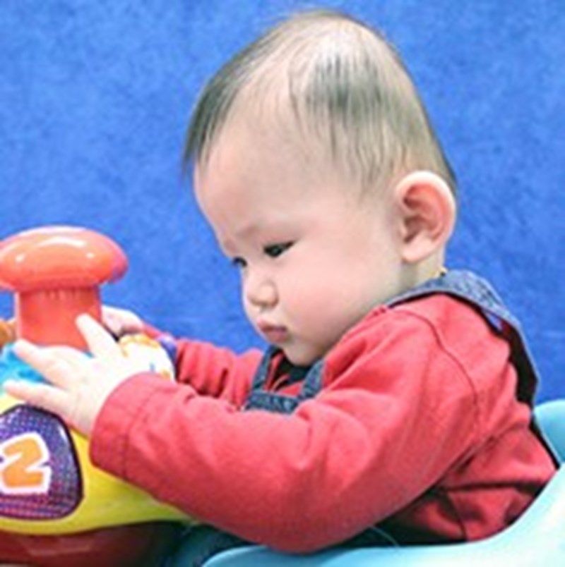baby with severe plagiocephaly