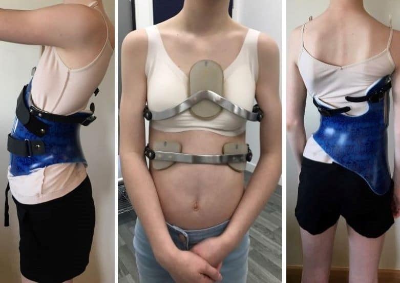 Daisy in her customised scoliosis brace as well as her pectus brace