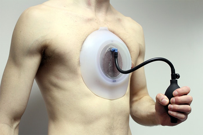 Patient wearing the vacuum bell to address pectus excavatum deformity