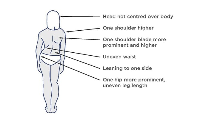 How to tell if your child has scoliosis. Look for symptoms like their head not being centred over the body, one shoulder higher than the other, leaning to one side and one hip appearing more prominent than the other