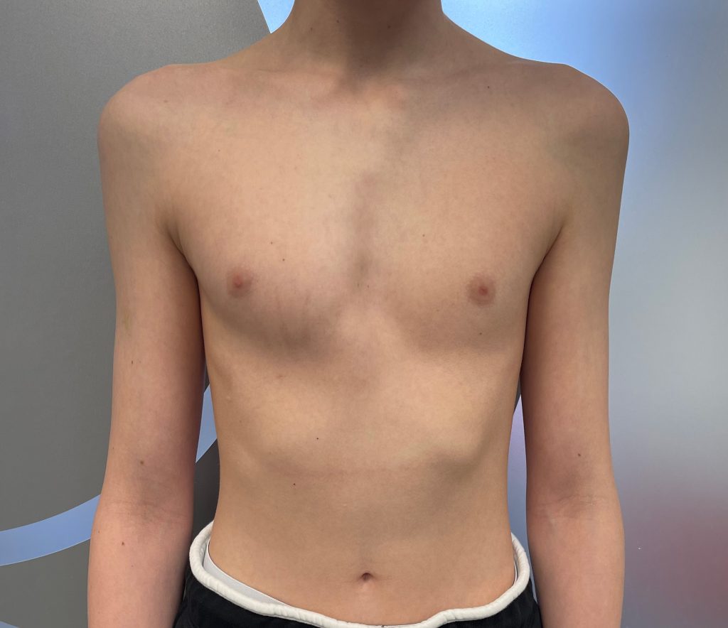 Aris' chest showing signs of both pectus carinatum, pectus excavatum, and rib flaring before treatment