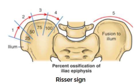signs of Risser