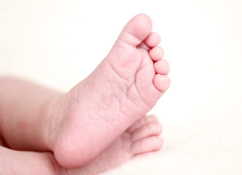 Club foot baby feet