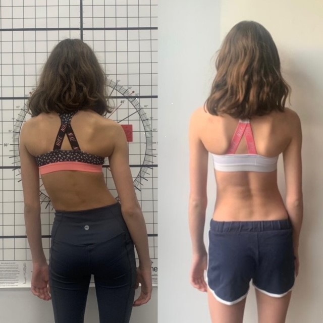 Adolescent scoliosis patient showing spinal curve before and after bracing treatment at the London Orthotic Consultancy