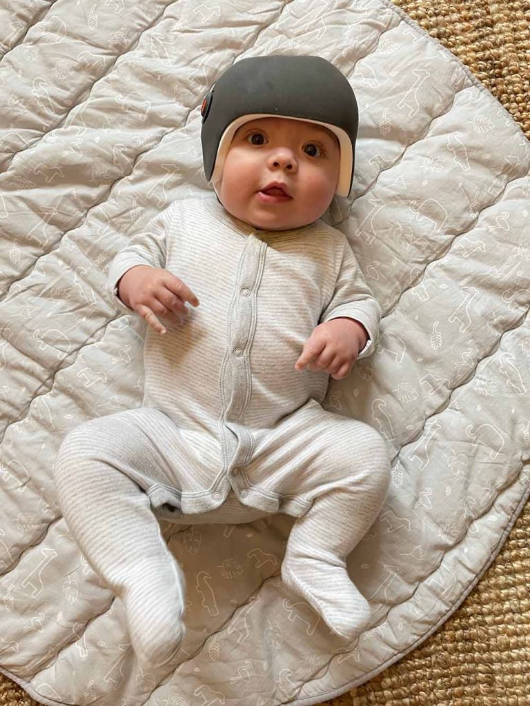 Baby Billy in his cranial remoulding helmet