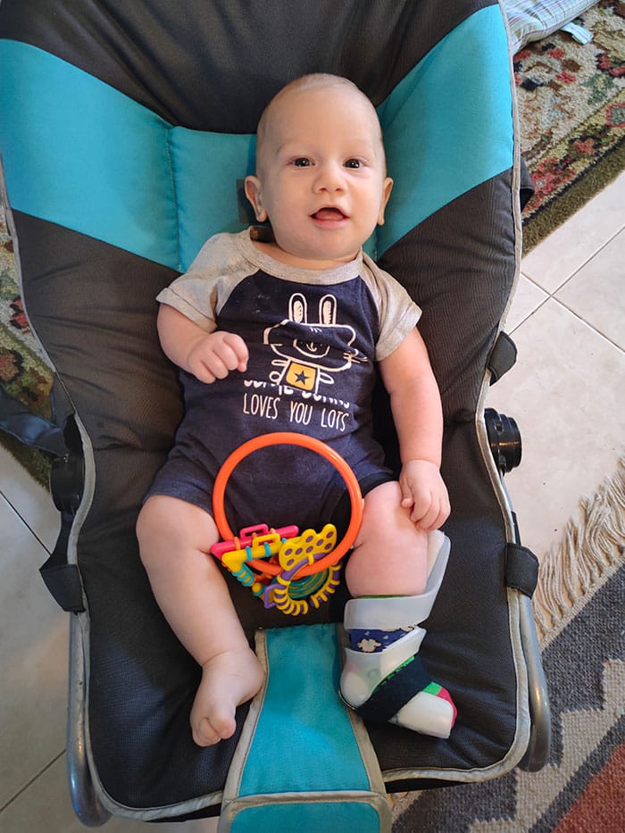 Baby wearing in the flexible Cunningham club foot brace smiling
