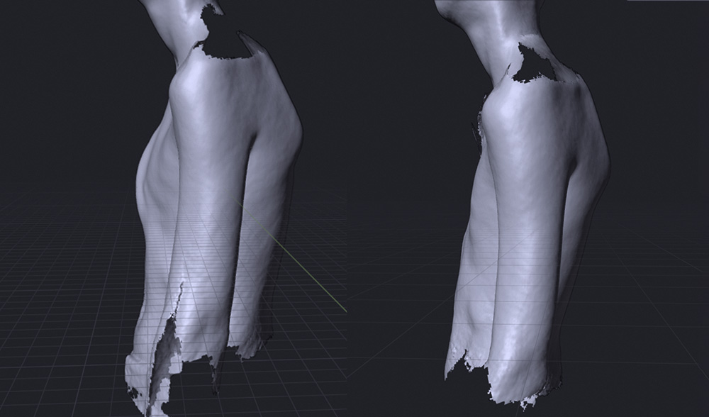 Pectus carinatum scan before and after bracing treatment at the London orthotic consultancy