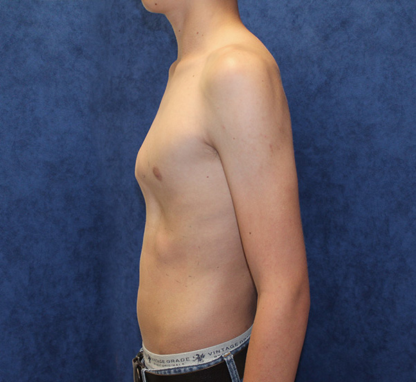 pectus carinatum pectus deformity bracingtreatment
