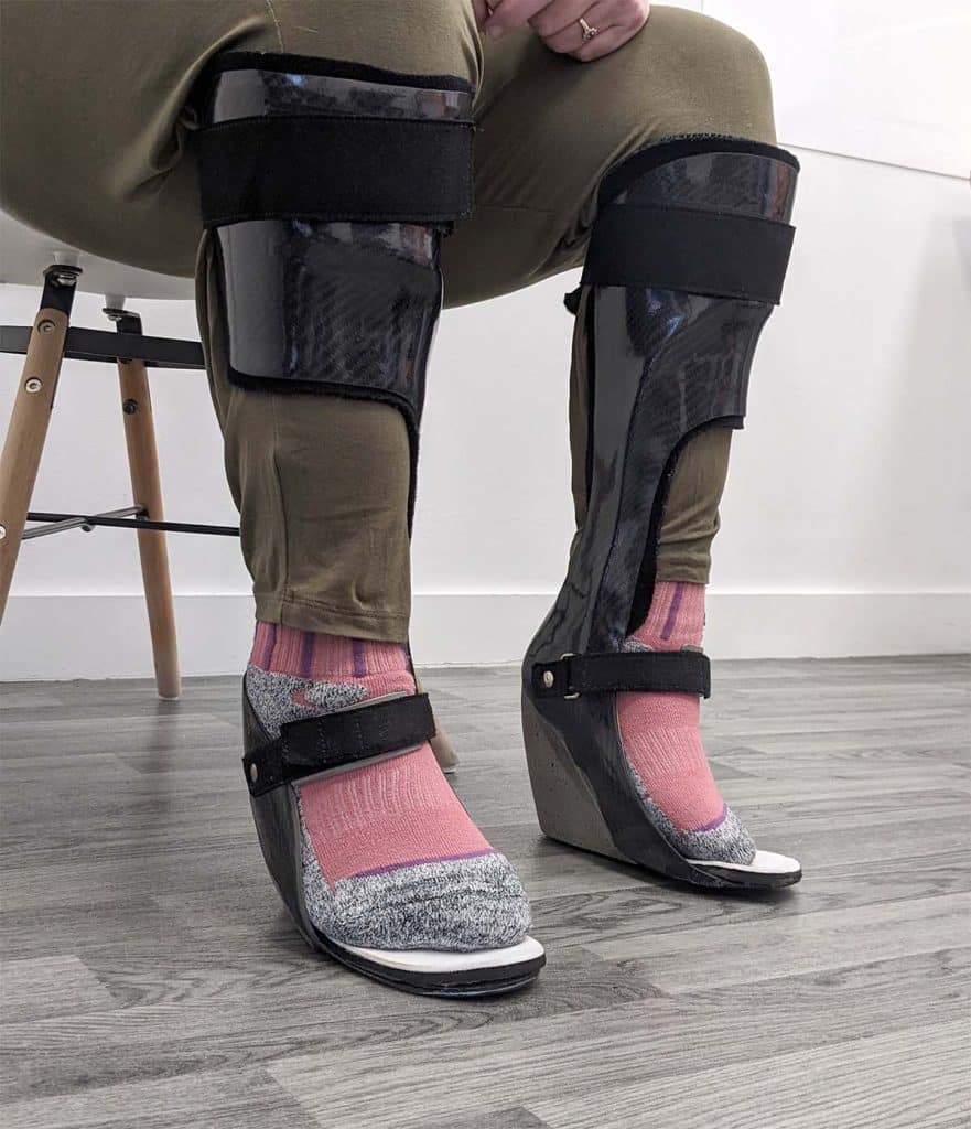 Patient trying out her new bespoke carbon fibre orthoses