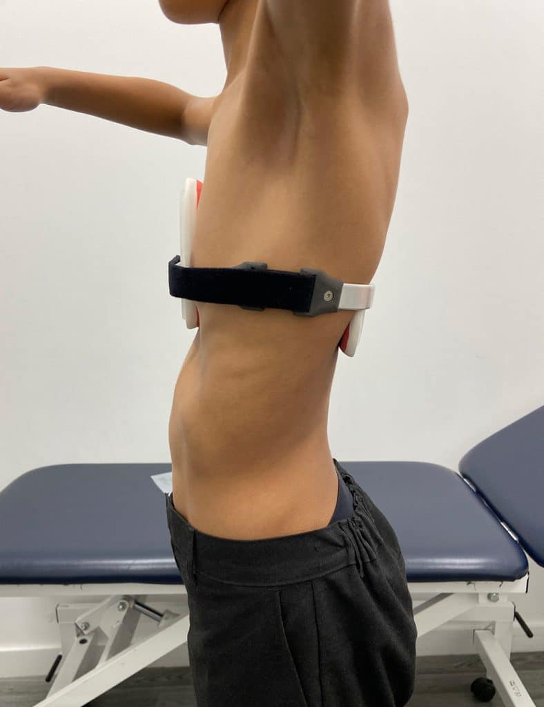 Side view of the bespoke pectus carinatum dynamic chest compressor brace