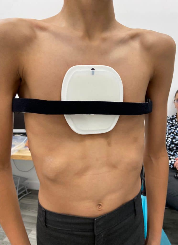 London Orthotic Consultancy pectus carinatum brace