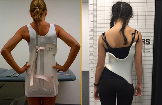 Boston brace (left), Cheneau-Gensingen brace (right)