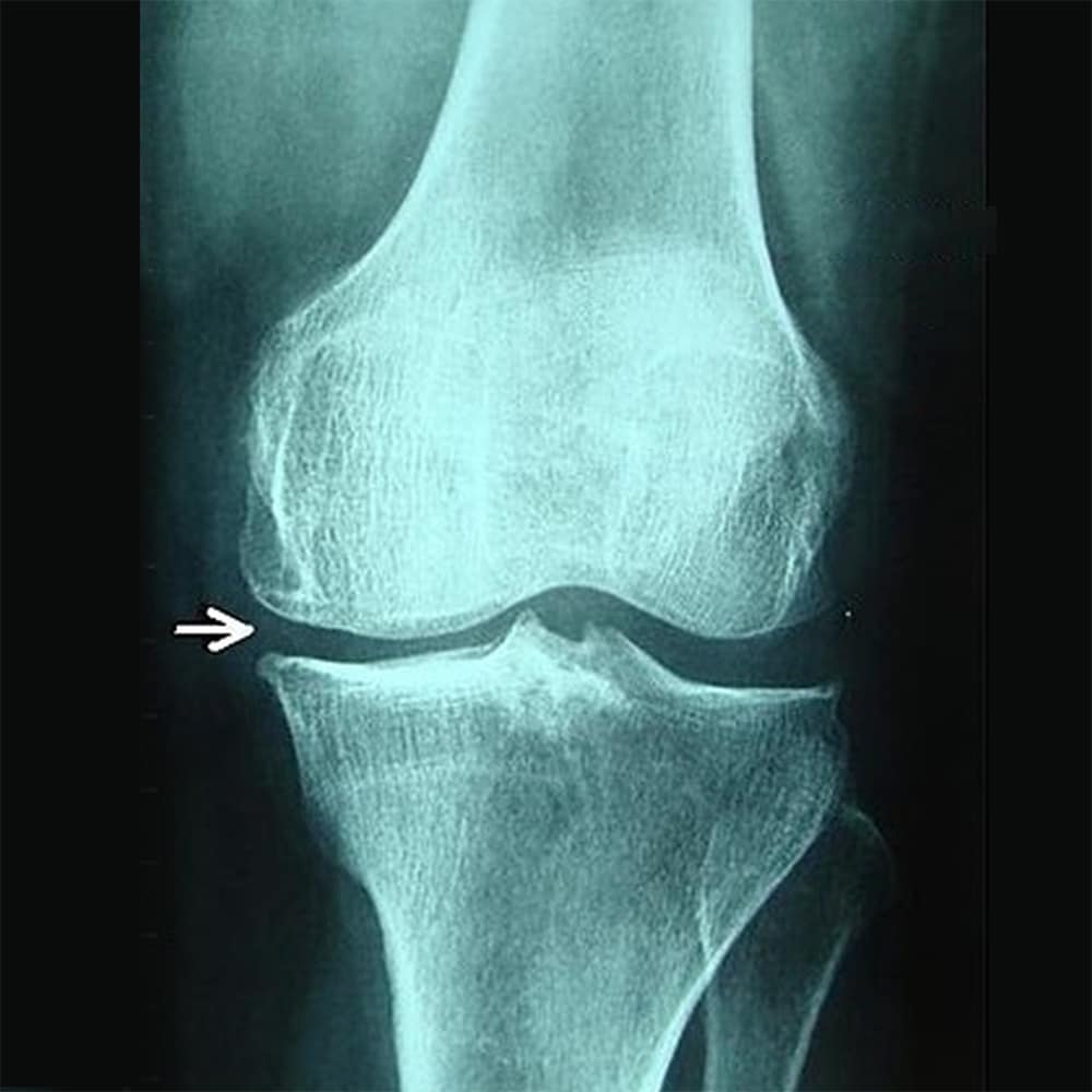 Osteoathritis